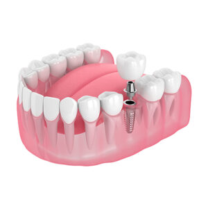 Graphic Depicting a Dental Implant for a Single Missing Tooth